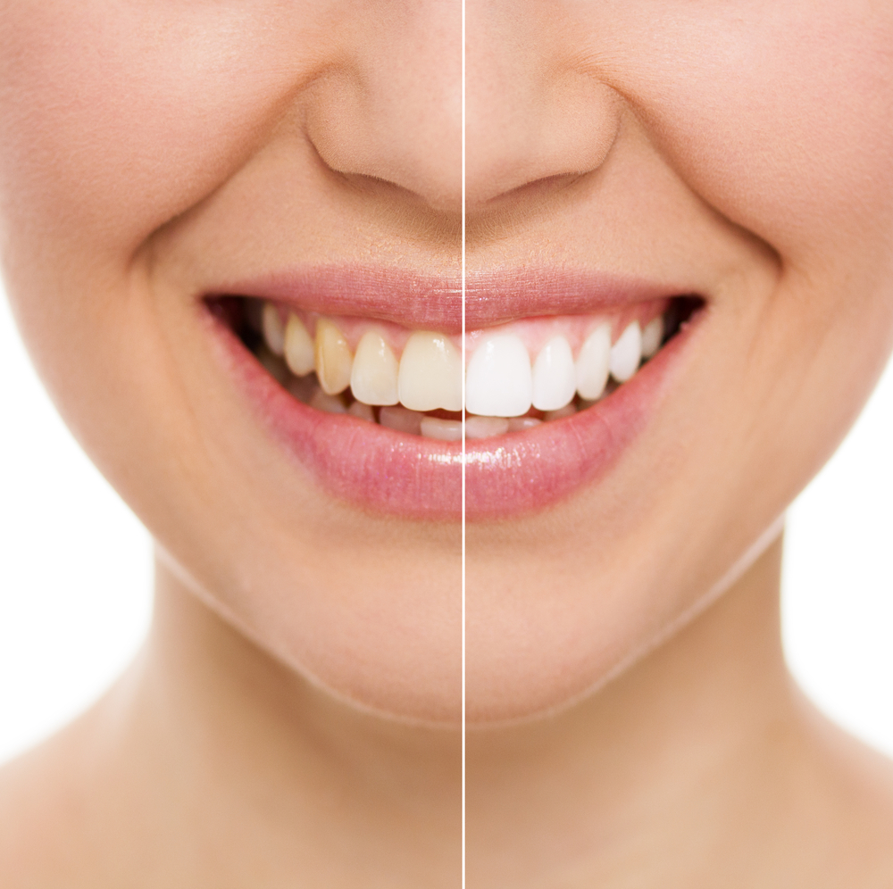 Vergleich zwischen bleaching und Zahnreinigung sowie normalen Zähnen
